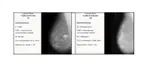 Breast Cancer Detection